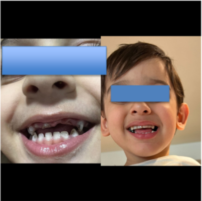 Full Mouth Rehabilitation under General Anaesthesia (GA) for Kids from Dubai, Now in Delhi, India