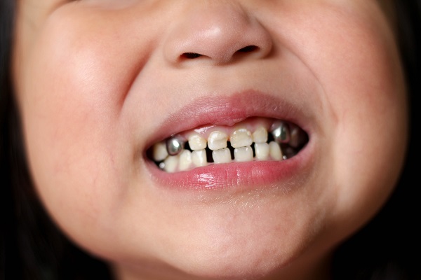 Kids Dental Crowns: Types, Benefits, and Why Your Child Might Need One